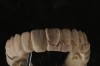 Fig 13. A copy of converted denture that was modified by shaping.